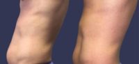 25-34 year old man treated with truSculpt flex