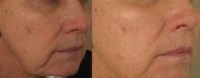 58 year old woman treated with Non Surgical Face Lift