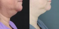 45-54 year old woman treated with WarmSculpting with SculpSure
