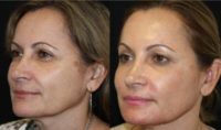51 year old woman treated with Injectable Fillers and Botox
