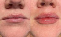 23 year old woman treated with Lip Filler