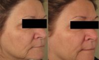 62 year old woman treated with Skin Rejuvenation