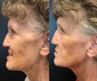 75 and up year old woman treated with Skinbetter Science