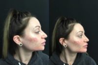 25-34 year old woman treated with Radiesse for Jawline