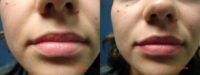 35-44 year old woman treated with Lip Fillers