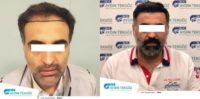 35-44 year old man treated with FUE Hair Transplant