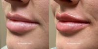 25-34 year old woman treated with Lip Fillers, Dermal Fillers, Juvederm