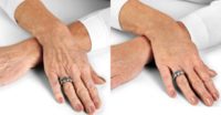 Woman treated with Hand Rejuvenation