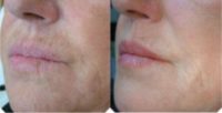 35-44 year old woman treated with Dermapen