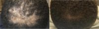 25-34 year old man treated with PRP for Hair Loss