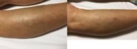 55-64 year old woman treated with Vein Treatment