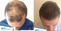 25-34 year old man treated with FUE Hair Transplant