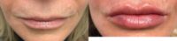 35-44 year old woman lip augmentation with Allergan family of injectables