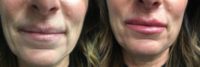 Woman treated with Lip Augmentation