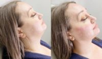 32 year old woman treated with Injectable Fillers for Chin Augmentation