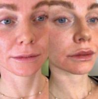 Woman treated with Restylane Defyne