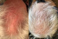 65-74 year old man treated with PRP for Hair Loss