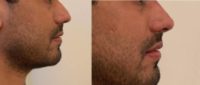 25-34 year old man treated with Nonsurgical Nose Job