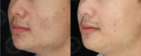 18-24 year old man treated with Acne Facial