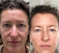 45-54 year old woman treated with Voluma, Dermal Fillers, Cheek Fillers, Juvederm, Botox