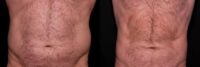 55-64 year old man treated with CoolSculpting