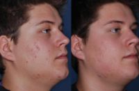 18-24 year old man treated with Chemical Peel