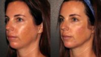 35-44 year old woman treated with Juvederm Volux and Voluma