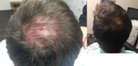 amazing hair restoration results - 35-44 year old man treated with PRP for Hair Loss