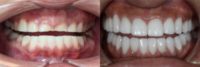 25-34 year old woman treated with Dental Crown