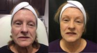 65-74 year old woman treated with Sculptra Aesthetic