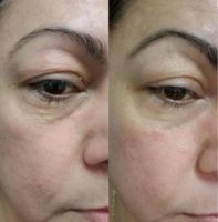 55-64 year old woman treated with Skin Tightening