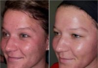18-24 year old woman treated with Chemical Peel
