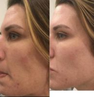 25-34 year old woman treated with Laser Genesis