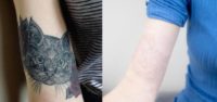 25-34 year old woman treated with Tattoo Removal