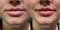 25-34 year old woman treated with Lip Fillers, Dermal Fillers, Juvederm