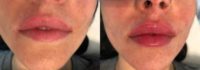 35-44 year old woman Lip Augmentation with Revanesse Versa