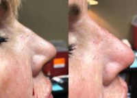 55-64 year old woman treated with Nonsurgical Nose Job