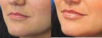 Lip Enhancement with Juvederm Vollure Dermal Filler