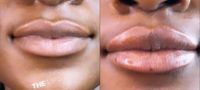 Woman treated with Lip Fillers, Dermal Fillers