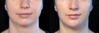 Woman treated with Juvederm, Dermal Fillers